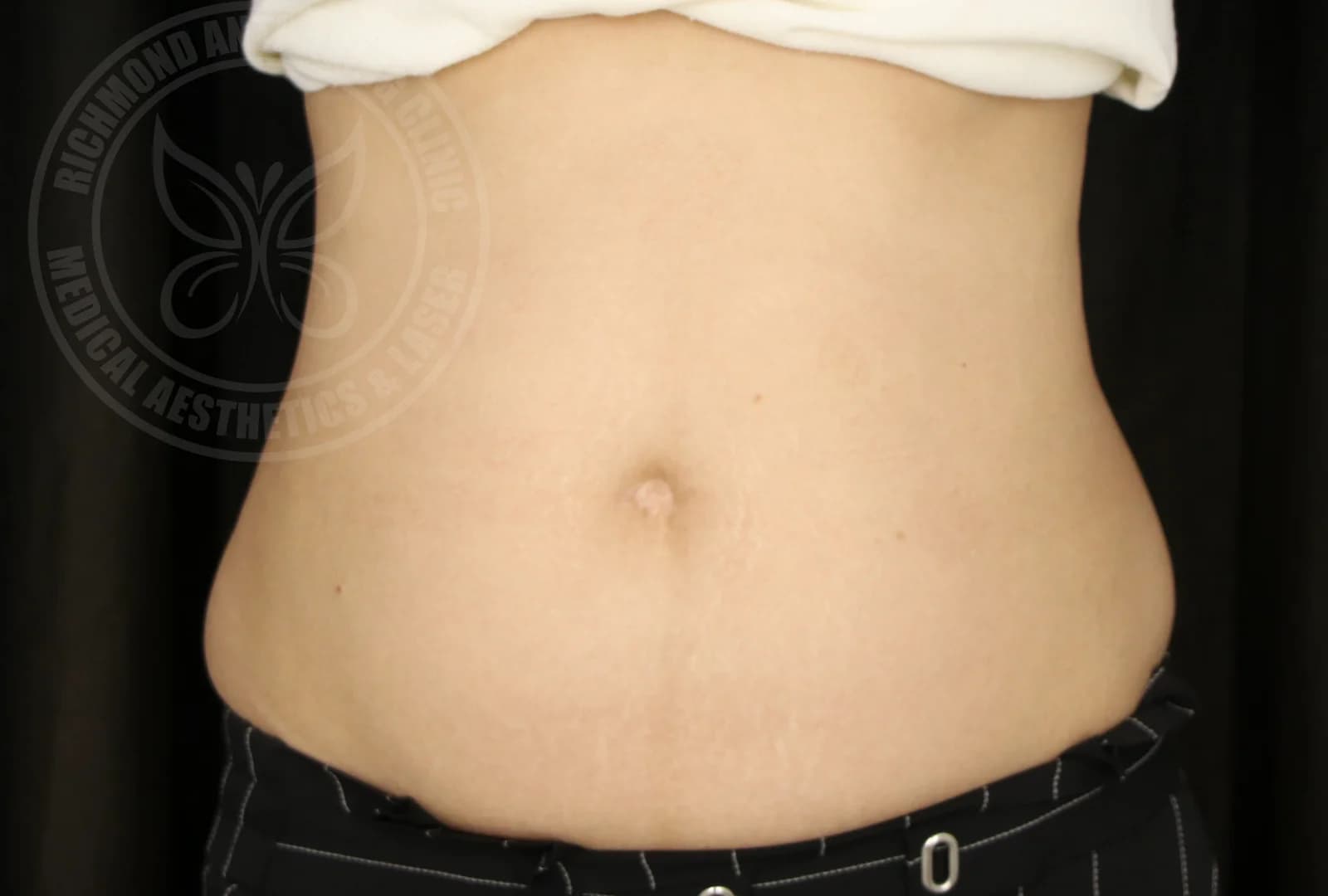 CoolSculpting Abdomen After