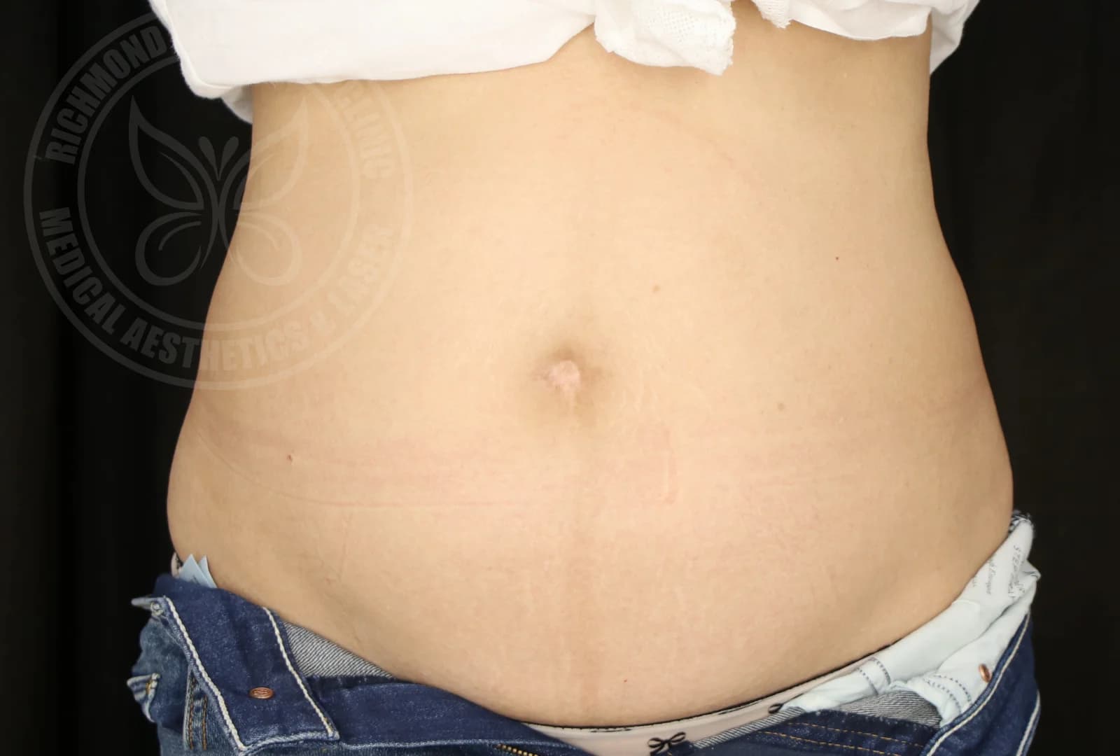 CoolSculpting Abdomen Before