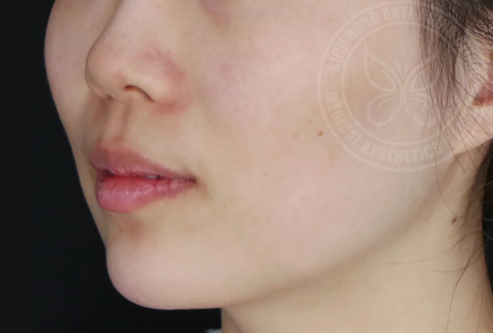 Lip Enhancement After