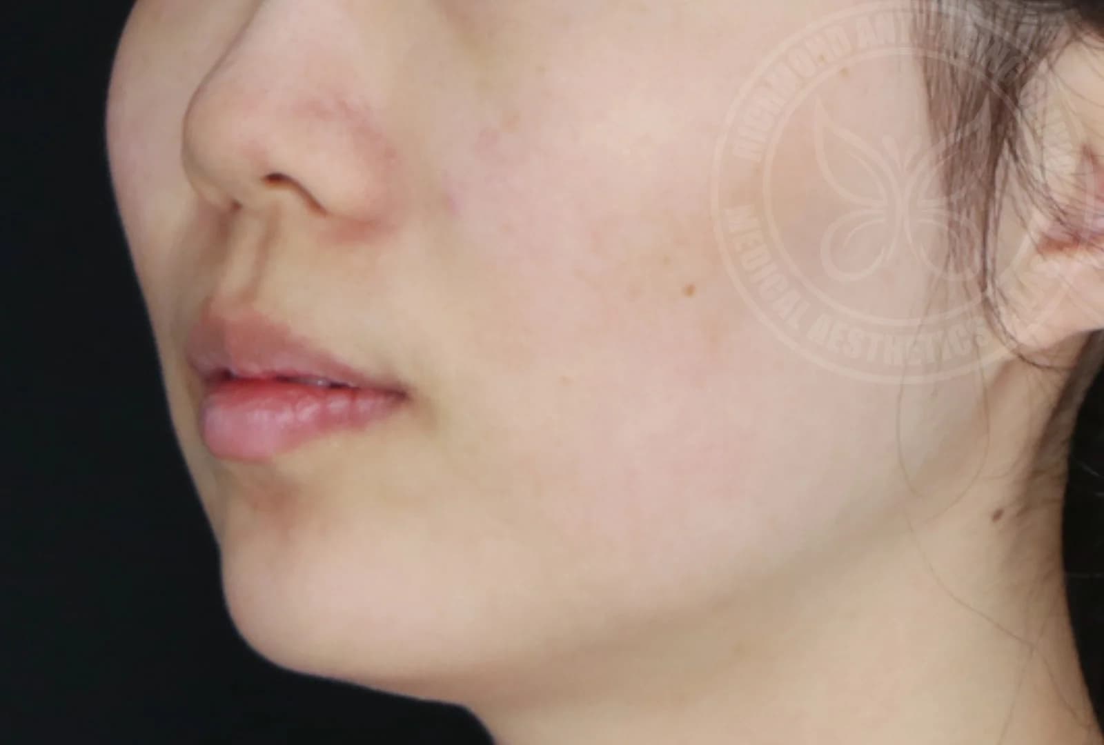 Lip Enhancement Before