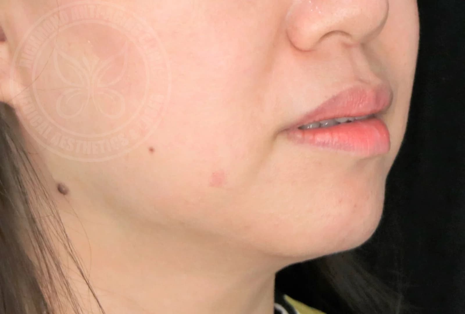 Ultherapy Lower Face Lift After