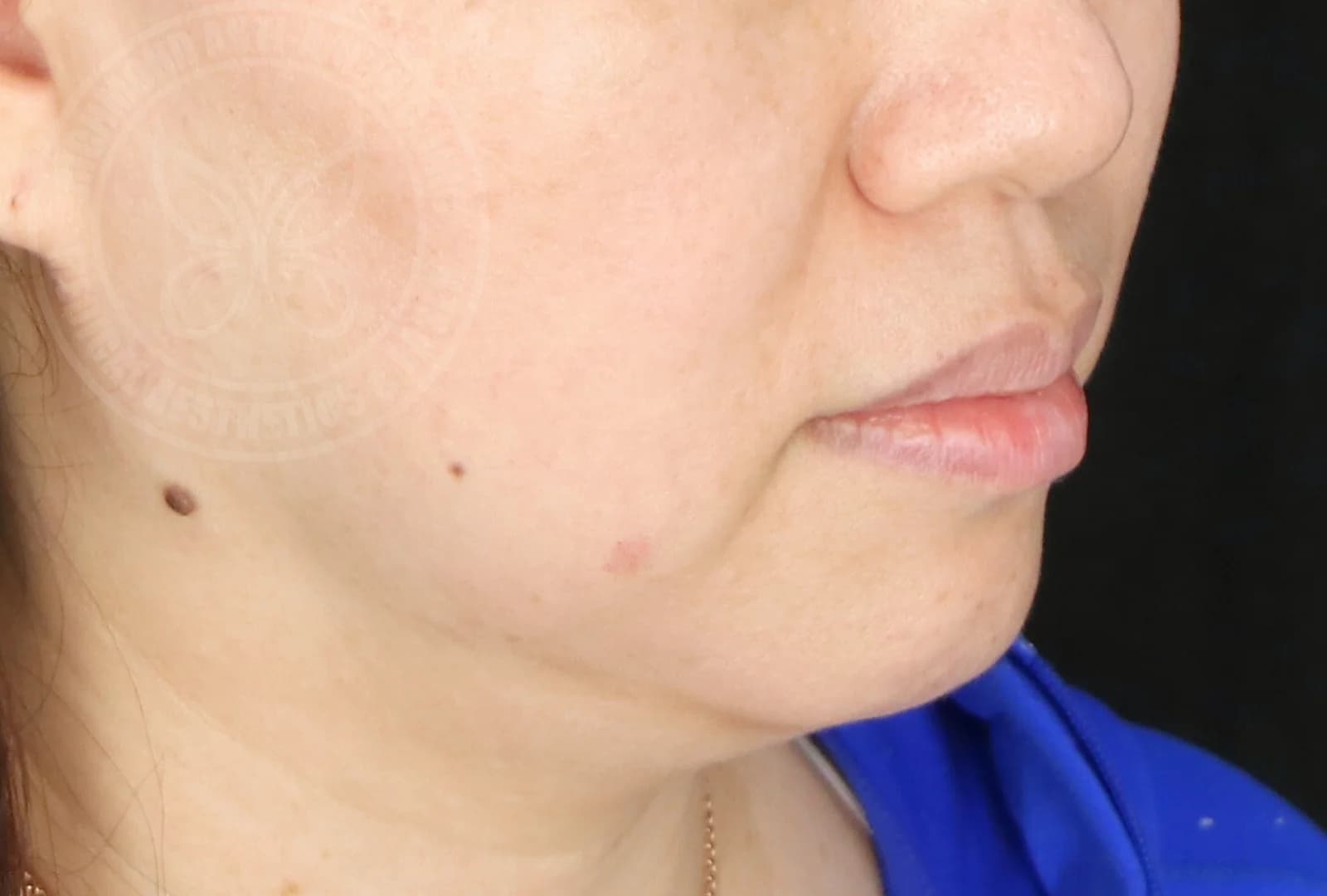 Ultherapy Lower Face Lift Before